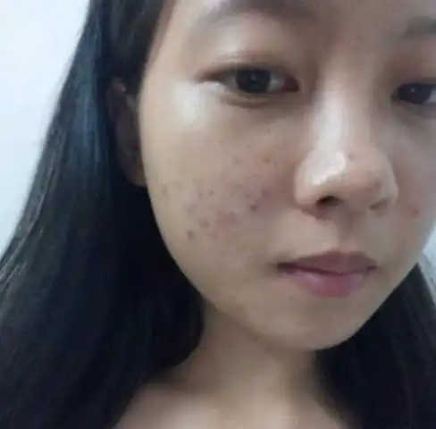 女生脸上出油长痘痘严重3种水果常吃,排毒养颜告别青春痘