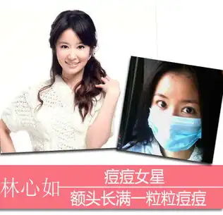 痘痘女王翻身计周迅蔡依林等女星私授祛痘经