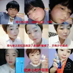 脸部的红血丝裸脸,不同任何护肤品修复会不会加重,会自愈吗?-黄页88网