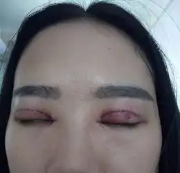 南方医科大学深圳医院医学博士导致少女毁容怎么维权在线等很急,眼睛皮被多割了差点导致失明
