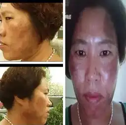 郑州一女子美容变毁容看完后感叹套路太深