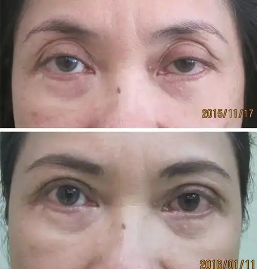 眼部专题重睑线过宽修复术经验分享