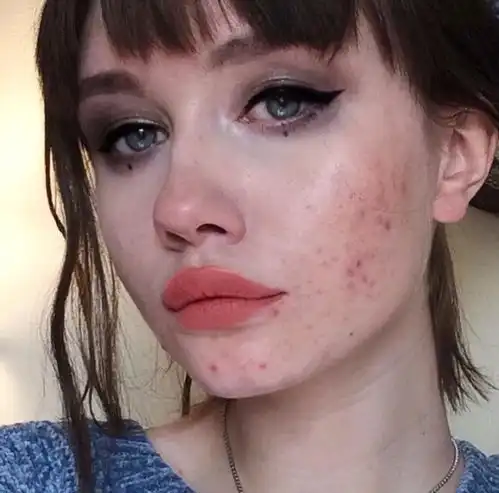 蜂蜜绿茶系暗疮救星外国女生ko痘痘肌,全靠两招天然嫩肤方法