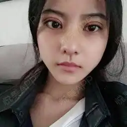 和小仙女们分享下我的鼻综合和眼综合整形日记主要是...鼻综合悦美整形