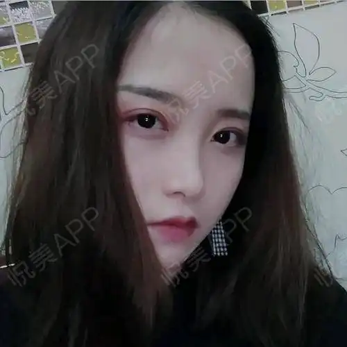 几乎每个女孩子都想要拥有一双大眼睛我也是其中的一个...眼部多项悦美整形
