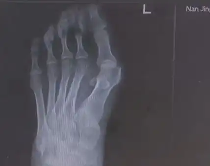 爱穿高跟鞋的女性一定要小心,拇指外翻堪比裹脚不可忽视