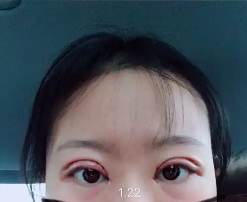 有心美女的双眼皮开眼角案例作业