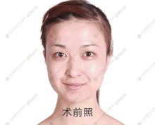 打玻尿酸对怀孕居然有这么大的影响