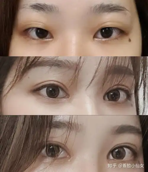 全切双眼皮开眼角,女生对自己够狠才能更美