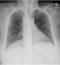 女,79岁,具有转移性黑色素瘤史