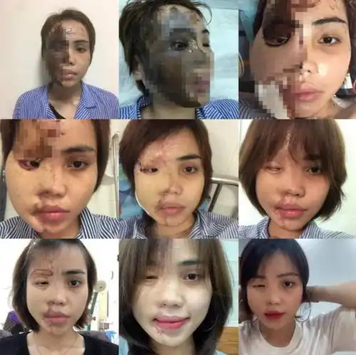 恐怖美女网红惨遭未婚夫泼酸毁容,3年21次手术后今励志重生