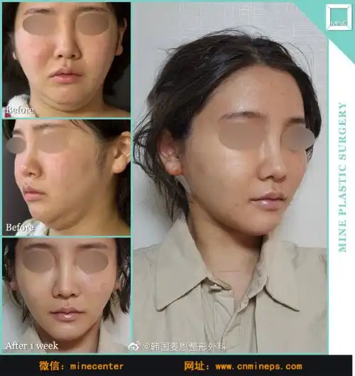 麦恩韩国双下巴吸脂看真人案例了解奶奶线少女线的差距