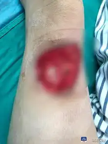 女子做丰臀手术被烧伤,男友分手,索赔95万还遭拒