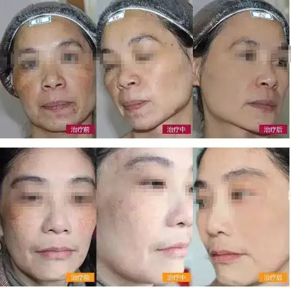 99女生都犯过的去斑误区,你中了几个