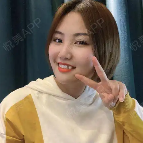 我从小就是个小胖子,后面经过运动减肥终于比以前要瘦...瘦脸悦美整形
