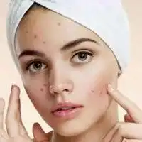 女性微信头像痘痘