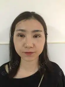 大眼睛是每个女孩子想要的,但是我两只眼睛不对称,大...双眼皮悦美整形
