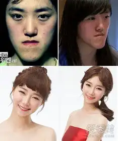 各国整形案例真人版芭比哪家强图