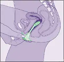 关于女性安全套用法的正确步骤
