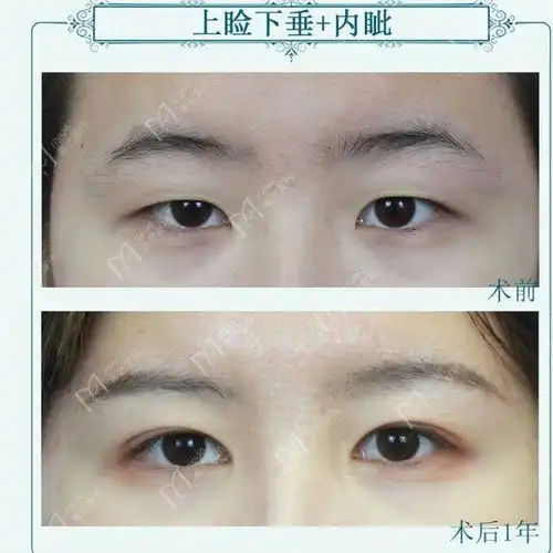 郑州90后小姑娘双眼皮做了2次显老,第3次修复后4个月自然年轻了