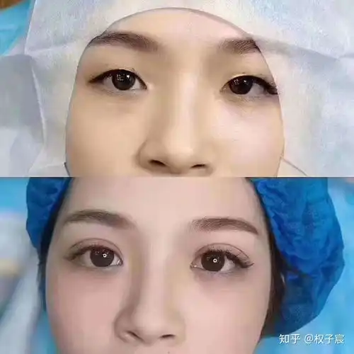 女生要不要做眼综合呢