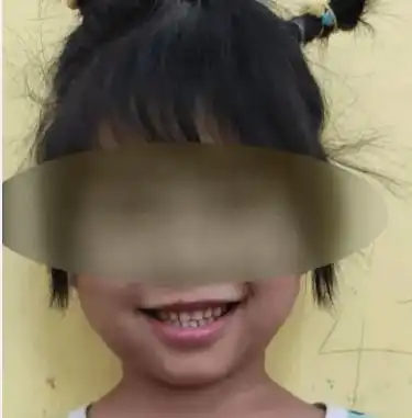 南宁5岁女童拔牙大出血脑死亡