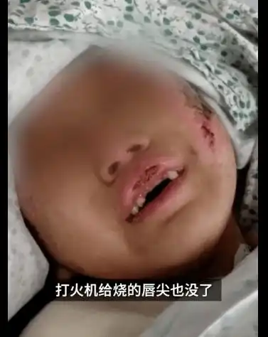 滚水浇头铁钳拔牙掰断胳膊6岁女童惨遭虐待律师执业24年最残忍案例