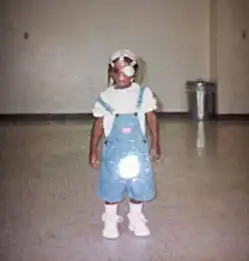 烧伤女孩面部狰狞被称作怪物拒绝做修复手术