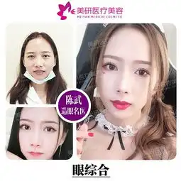 眼综合长沙元气少女眼综合割双眼皮开眼角五天拆线七天自然十天可上妆悦美整形