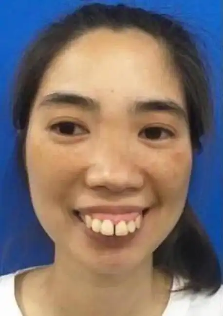 30岁女孩长得太丑无人敢追,做完整容手术美若天仙,亲妈都认不出