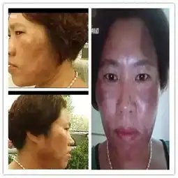 郑州女子美容变毁容如此免费