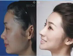 膨体垫下巴会有什么后遗症吗