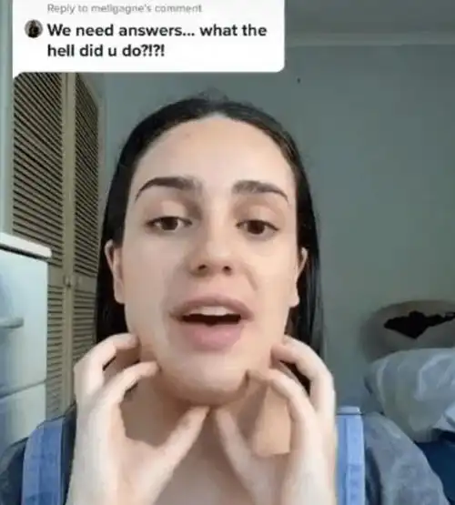 女子整容失误,意外弄成了方形下巴,网友看到照片,笑傻了