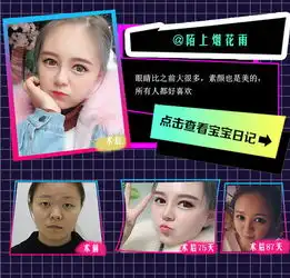 韩式埋线双眼皮埋线双眼皮元气少女猫咪脸眼睛睁大了整个世界都亮了送红蓝光修复悦美整形
