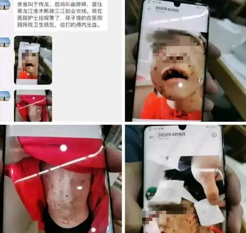 黑龙江佳木斯疑遭继母虐待的4岁小女孩生母发声将争取抚养权
