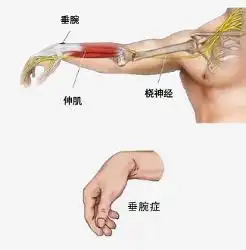 桡神经
