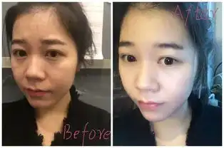 惊了大s无处安放的少女感源自台湾的皮秒镭射净肤无针水光只要399,与女明星一起冻龄