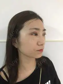 大眼睛是每个女孩子想要的,但是我两只眼睛不对称,大...双眼皮悦美整形
