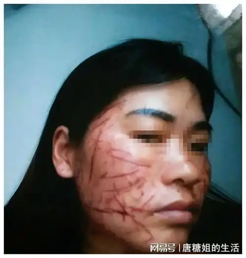 安徽一女子被小三割脸百刀,险些毁容,儿女活该,支持爸爸