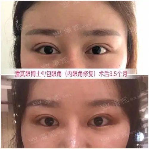 开眼角过大反面教材少女感不再脸比例失衡说不出的奇怪