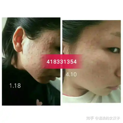 痘痘是每个女人的噩梦,包括我也曾经因为它自卑了很久