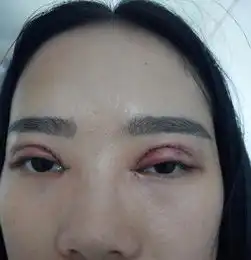 南方医科大学深圳医院医学博士导致少女毁容怎么维权在线等很急,眼睛皮被多割了差点导致失明
