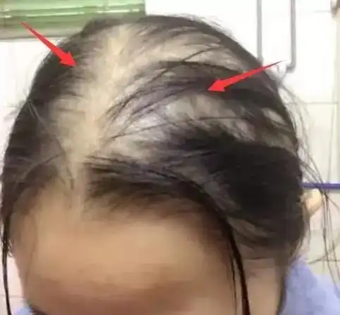 雌激素过低的女生,八成有这3特征,一个不占,偷乐吧