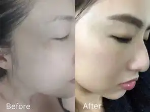 惊了大s无处安放的少女感源自台湾的皮秒镭射净肤无针水光只要399,与女明星一起冻龄