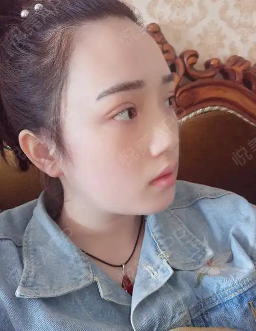 我是个很普通的单眼皮女孩子笑起来眼睛就没了,就是大...双眼皮悦美整形
