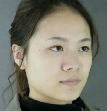 成都美黎美做隆鼻多少钱效果怎么样