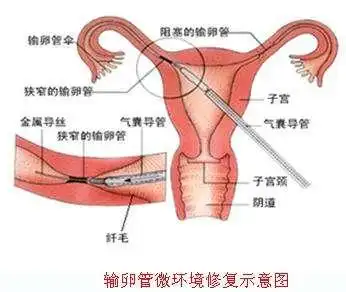 导致女生输卵管不通原因有哪些