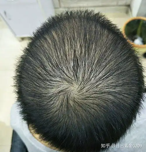 女生脱发了那么多年的我,经历了无尽的心酸