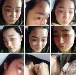 女教师与女生互殴致80几率留疤很恐怖