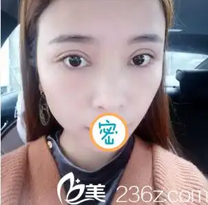找绵阳茗汇肖刚医生做了切开双眼皮开眼角手术我也是大眼女神啦